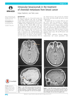 Intraocular bevacizumab in the treatment of choroidal metastases from breast cancer