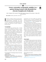 Lower extremity ecchymotic nodules in a patient being treated with ibrutinib for chronic lymphocytic leukemia