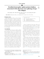Pretibial dystrophic epidermolysis bullosa associated with aberrant exon splicing of type VII collagen